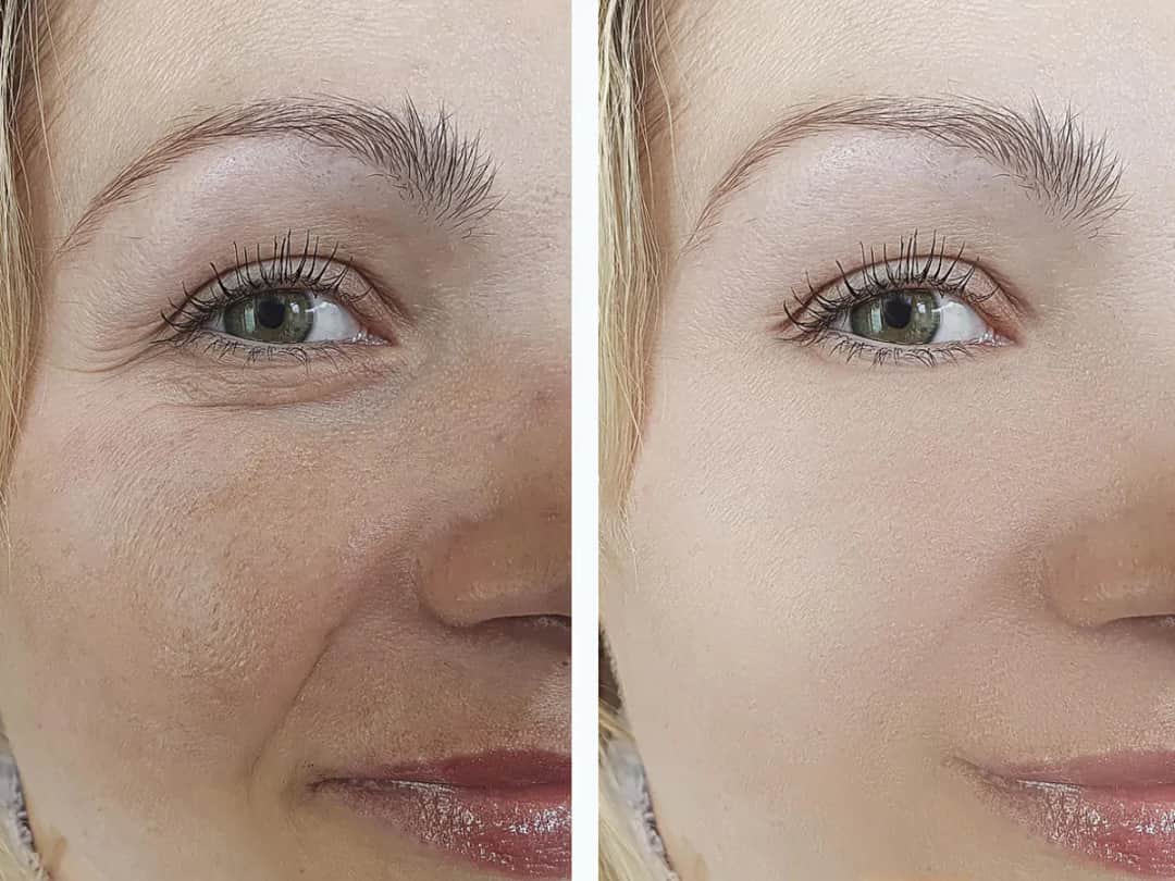 Czy po mikrodermabrazji można się malować? Ważne zasady i porady