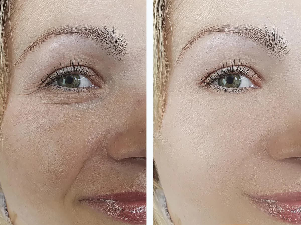 Czy po mikrodermabrazji można się malować? Ważne zasady i porady