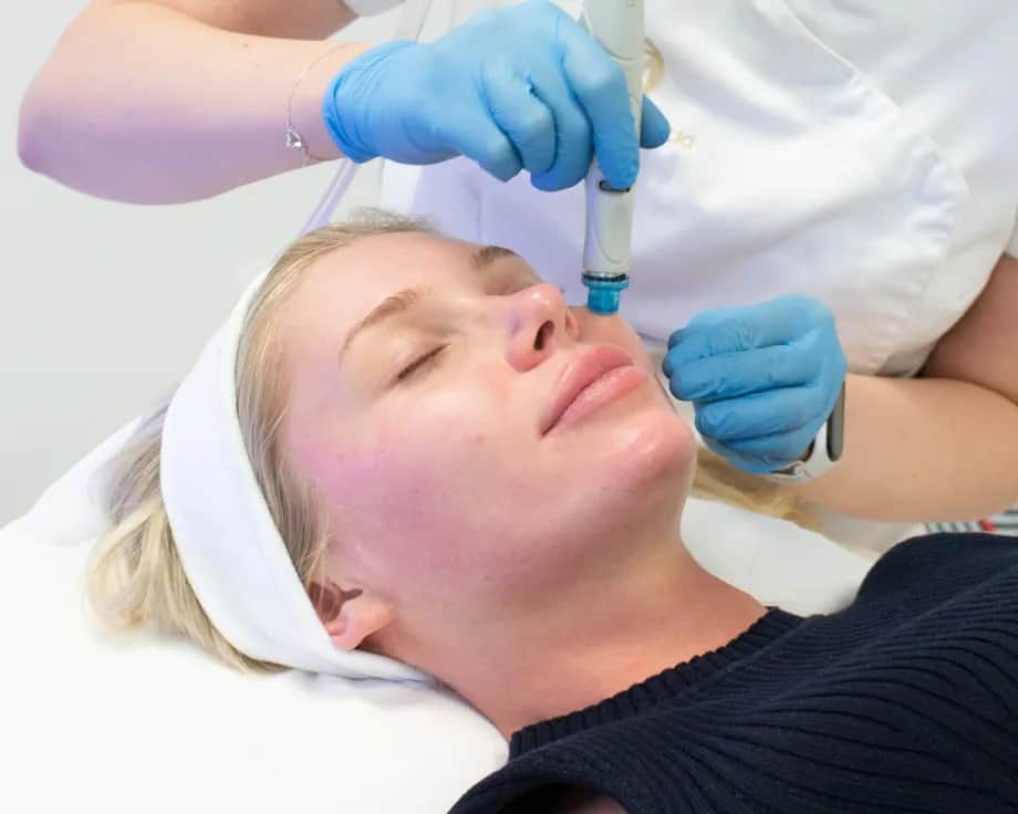 Jak wygląda twarz po mikrodermabrazji? Efekty i najczęstsze reakcje